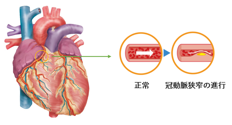 狭心症