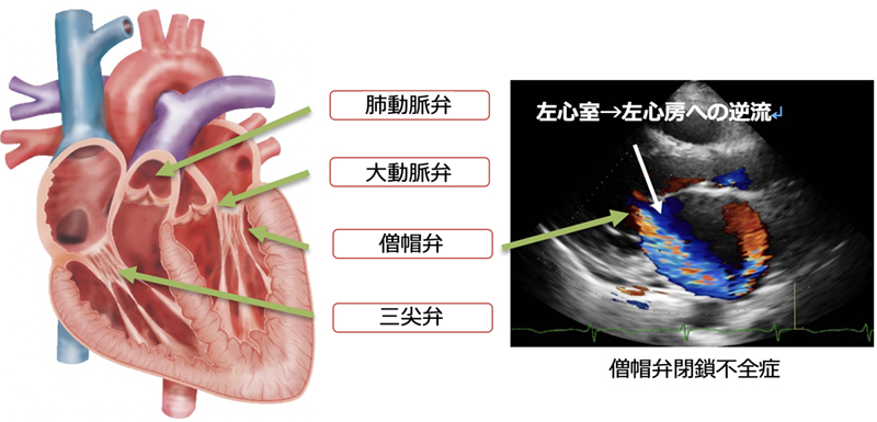 心臓弁膜症