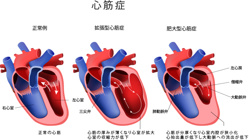 心筋症