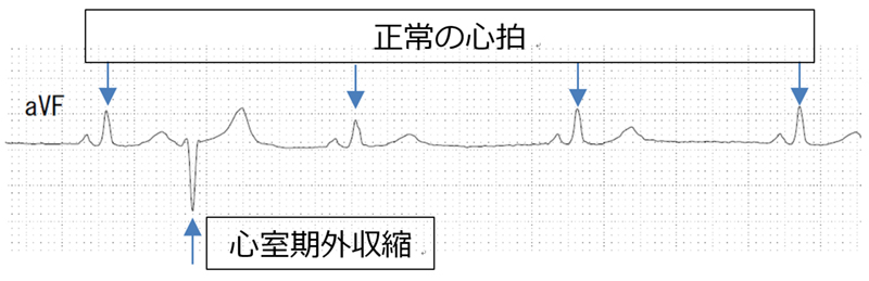 右心不全