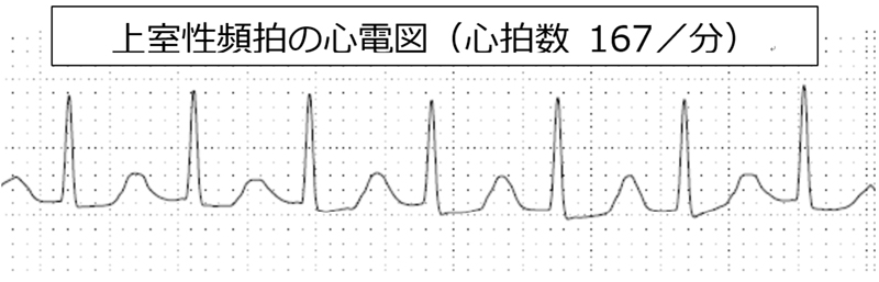 頻脈性不整脈