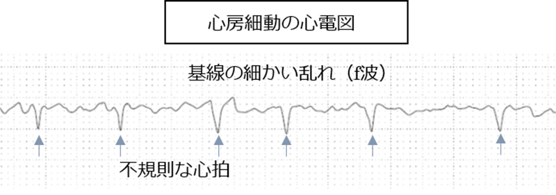 心房細動