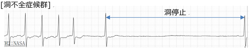 徐脈性不整脈・ペースメーカー